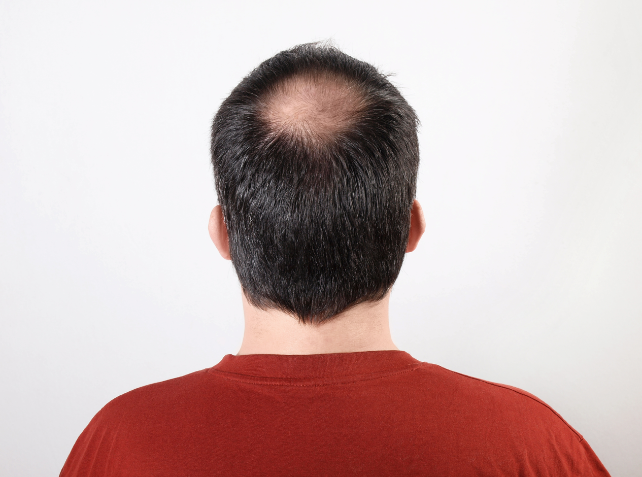 A man seen from behind with a bald spot on his scalp and thinning hair. Concept of thinning hair in men, hair loss tips, thinning hair treatment